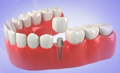 Dental implant in one day