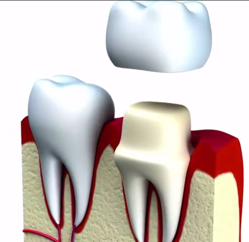 Detecting Tooth Decay Under Crowns Elsinore Smiles