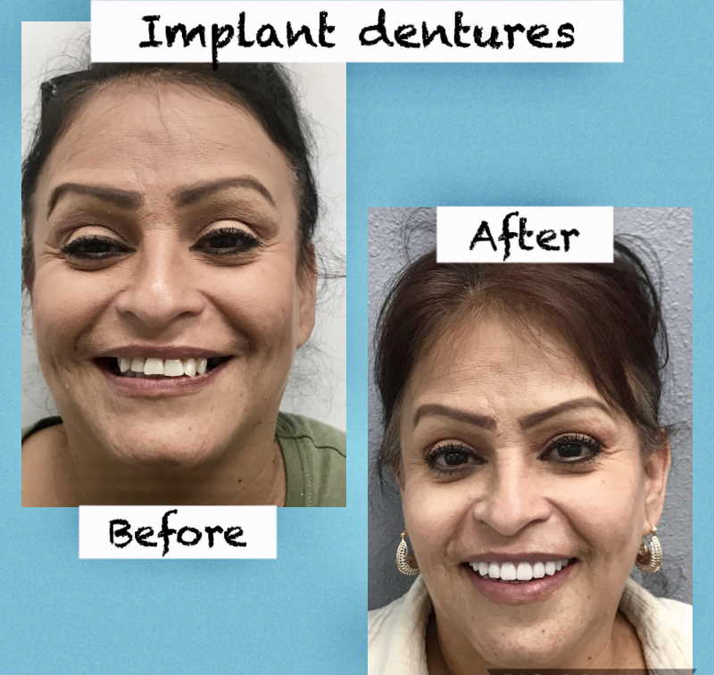 Dental Implants Before and After Full Mouth, All on 4, Results, Images