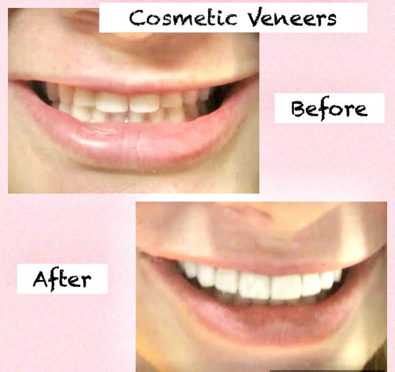 Veneers Before and After Porcelain, Composite, Gaps, Results