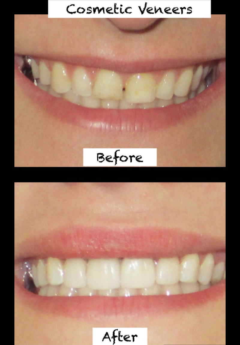 Veneers Before and After Porcelain, Composite, Gaps, Results